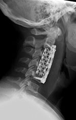Cervical spine fusion cage and anterior cervical fixation plate